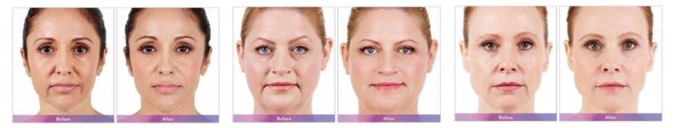 Juvederm