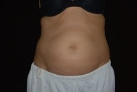 CoolSculpting